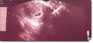 На какой неделе беременности эмбрион прикрепляется к матке