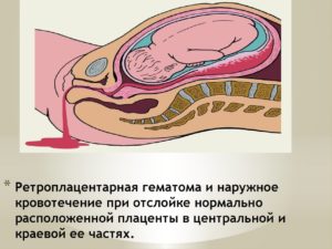 Боли при отслойке плаценты на поздних сроках