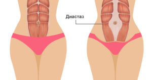 Как определить есть ли диастаз живота после родов