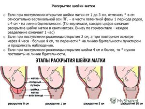 Раскрытие шейки матки на 4 см когда рожать