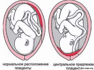 Низкая плацентация при беременности в 12 недель