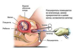 Можно ли забеременеть после чистки