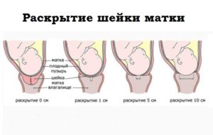 Размягчение шейки матки перед родами в домашних условиях