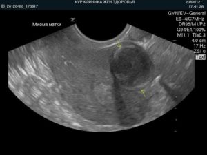 Интерстициальный узел по передней стенке матки при беременности
