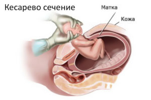 Матка после кесарева плохо сокращается матка что делать