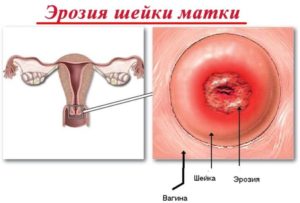 Мягкая матка при осмотре что это значит