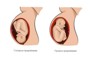 Тазовое предлежание плода на 25 неделе беременности