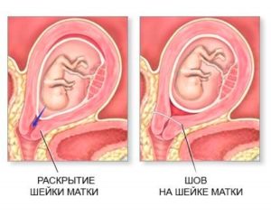 Тонус матки из за запора при беременности