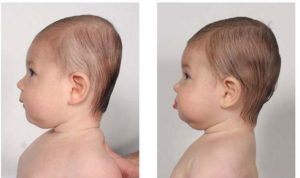 Брахицефалическая форма головы у ребенка