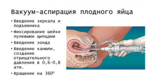 Вакуум аспирация после родов