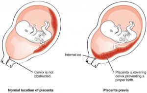 Плацента низко по передней стенке в 13 недель