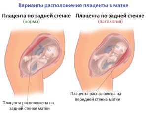 Плацента расположена по задней стенке матки низко расположена