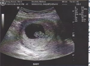 При каком хгч виден эмбрион на узи