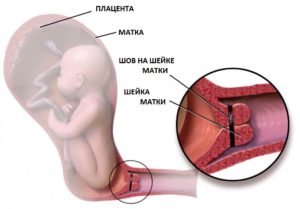 Мягкая шейка матки при беременности 30 недель причины