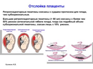 Ретроплацентарная гематома при беременности