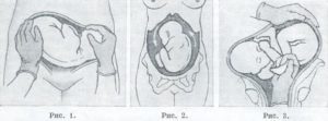 Низко расположена головка плода на 30 неделе беременности