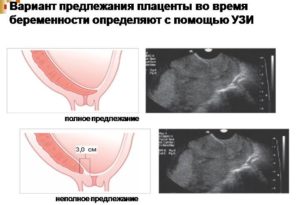 Плацента при беременности утолщена