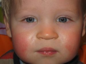 Почему красные щеки у младенца