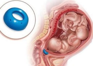 Зачем одевают кольцо на шейку матки при беременности