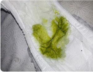 Темно зеленый кал при беременности