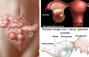 Киста яичника в менопаузе симптомы и лечение женщины