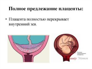 Предлежание плаценты по задней стенке перекрывает внутренний зев