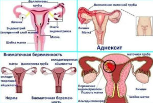 В матке тянущие ощущения