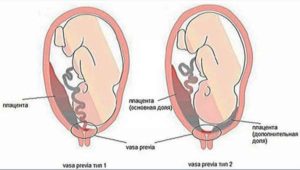 Форум низкое расположение плаценты при беременности 20 недель