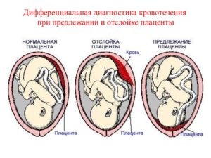 Бандаж при предлежании плаценты