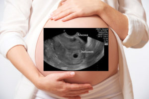 Можно ли спутать беременность с миомой на узи