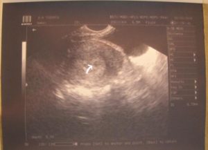 4 недели беременности на узи не видно эмбриона