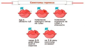 Простуда на губе при беременности 2 триместр лечение