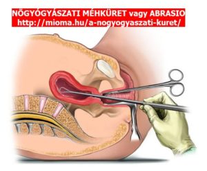 Чистка матки после родов ручная