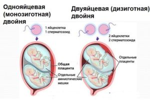 При многоплодной беременности редукция