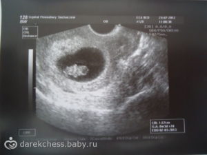 Первый месяц беременности узи