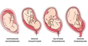 Низко расположена матка при беременности