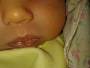 Пузырь на губе у новорожденного