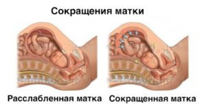 Тонус матки из за запора при беременности