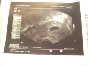 4 недели беременности на узи не видно эмбриона