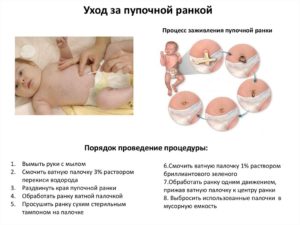 Обработка пуповины новорожденного алгоритм