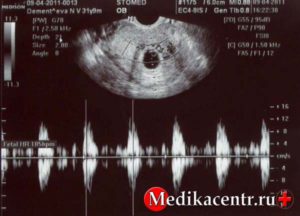 На какой неделе беременности слышно сердцебиение на узи