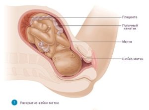 В роддоме дали таблетку для раскрытия шейки матки