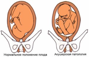 Как понять что плод перевернулся в головное предлежание