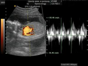 На какой неделе беременности слышно сердцебиение на узи