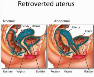 Матка ретрофлексио при беременности