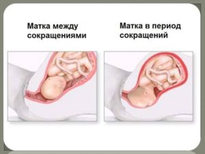 Как лучше лежать при тонусе матки при беременности