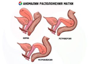 Матка отклонена кзади при беременности что это значит