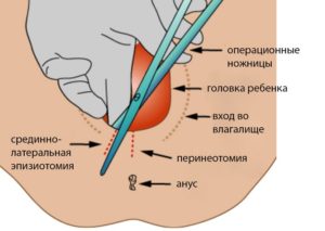 Швы после эпизиотомии когда рассасываются