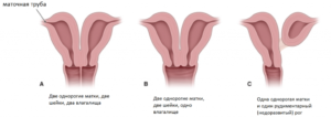 Две шейки матки у женщин