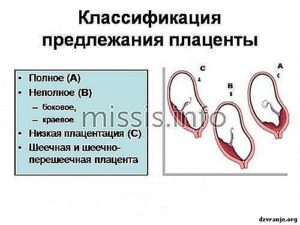 Низкая плацентация при беременности 21 неделя что делать